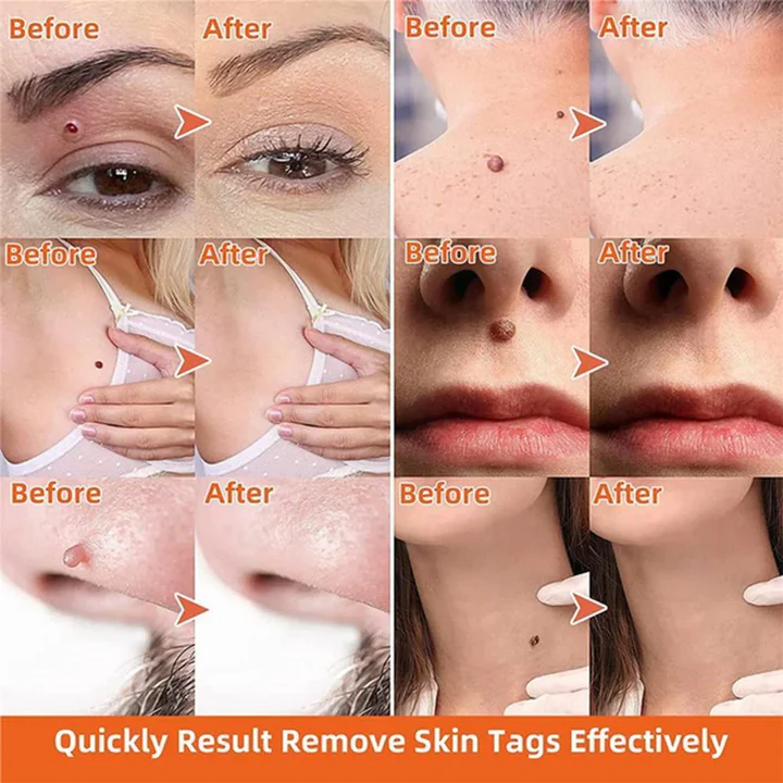 Fast Effective Mole and Tag Remover Kit