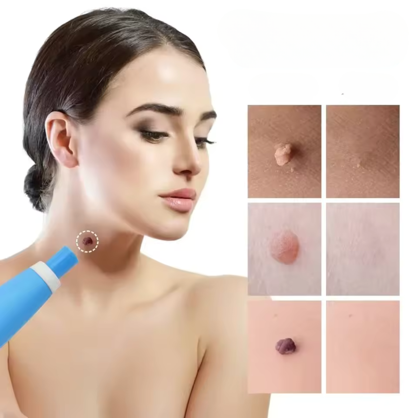 Effective Wart Removal Cream - Luxicro