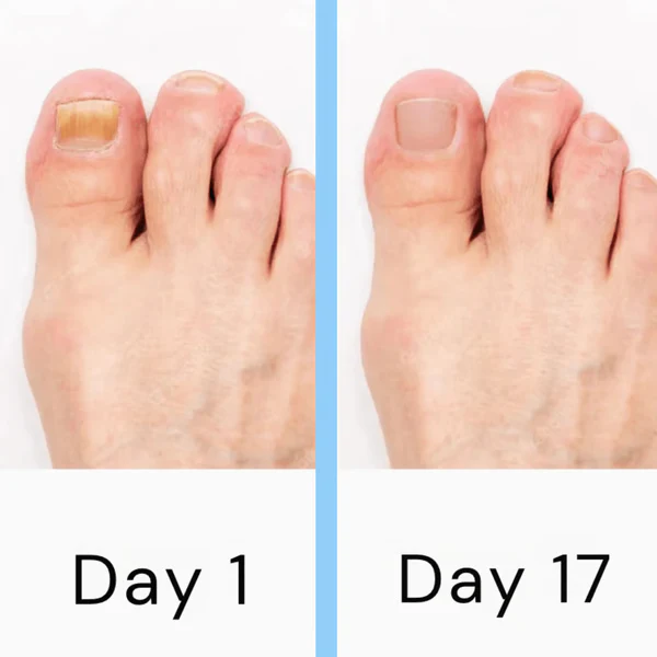 Advanced Nail Fungus Removal Laser Device