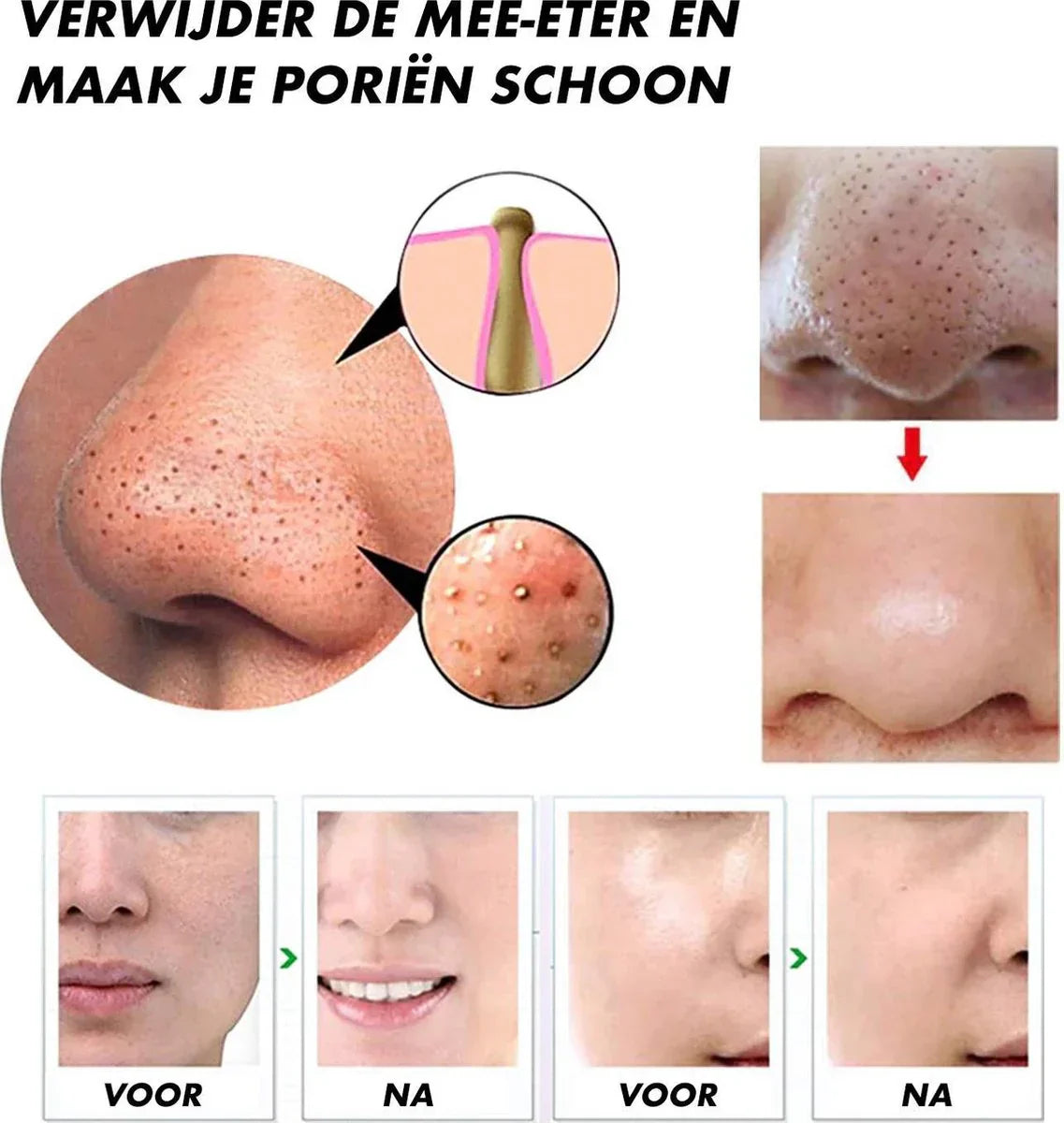 Deep Pore Cleaning Facial Blackhead Remover