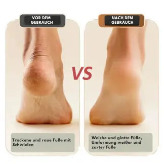 Fast Foot Callus Remover Kit