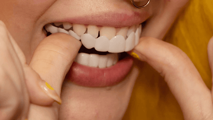 Easy Smile Makeover with Clip On Veneers