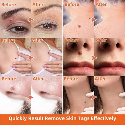 Fast Effective Mole and Tag Remover Kit