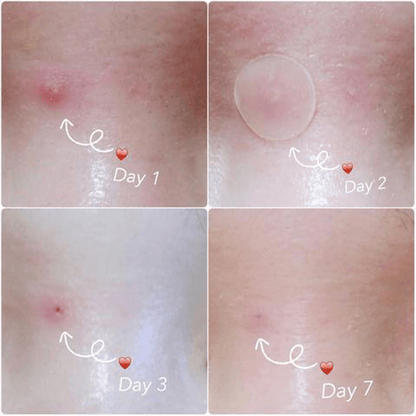 Quick Fix Acne and Spot Treatment Patches