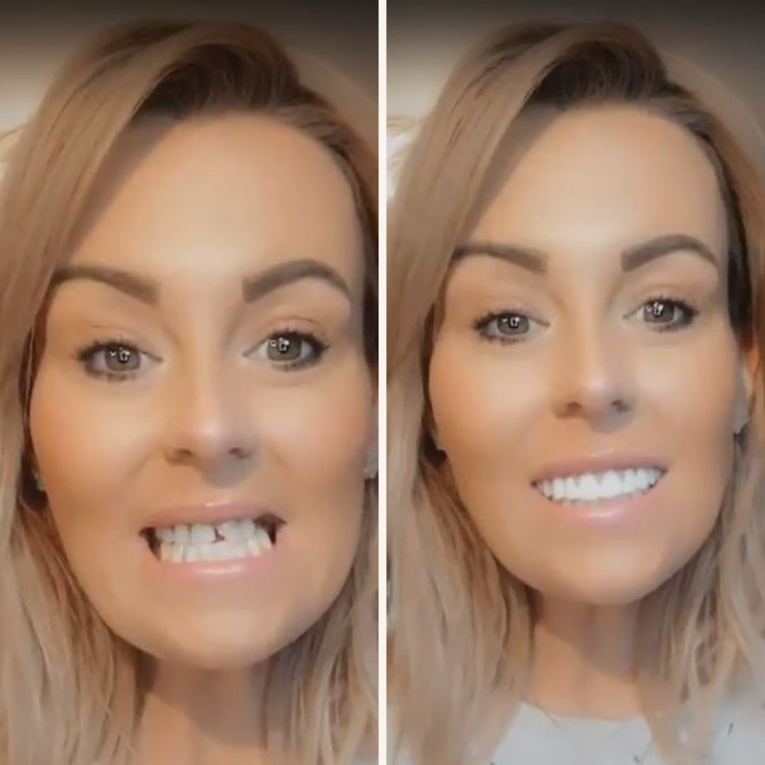 At Home Smile Veneer Kit Easy Tooth Repair