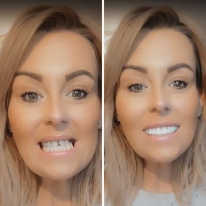 At Home Smile Veneer Kit Easy Tooth Repair