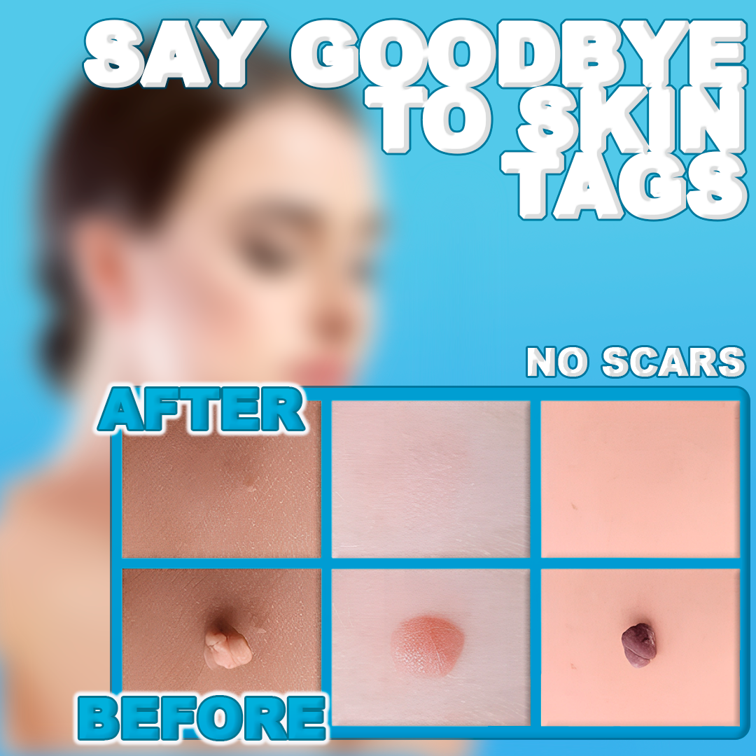 Easy Skin Tag Removal Tool