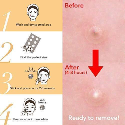 Quick Fix Acne and Spot Treatment Patches