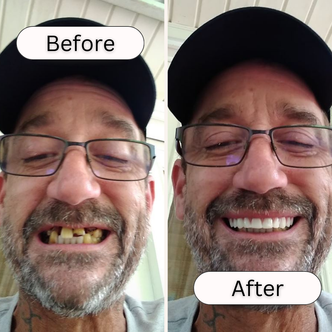 At Home Smile Veneer Kit Easy Tooth Repair