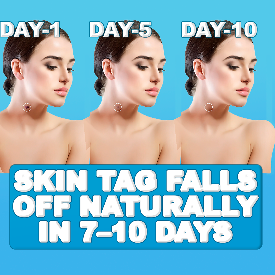Easy Skin Tag Removal Tool