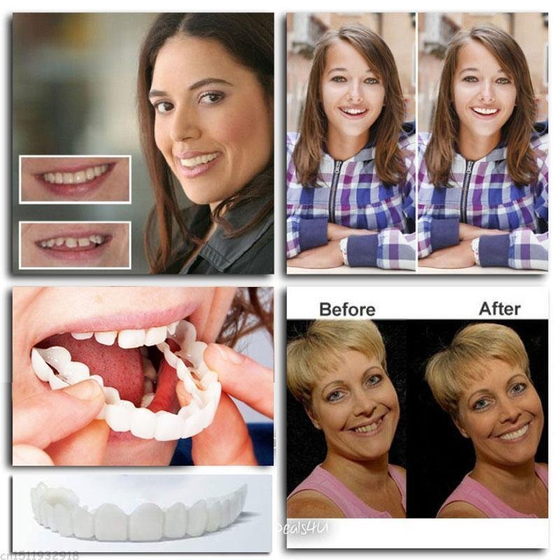 Comfortable Secure Clip In Dentures