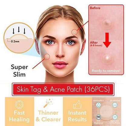 Quick Fix Acne and Spot Treatment Patches
