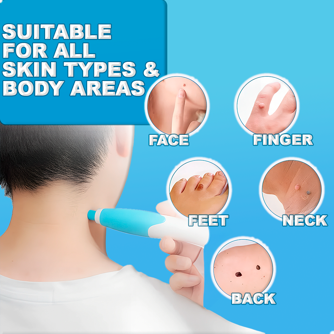 Easy Skin Tag Removal Tool