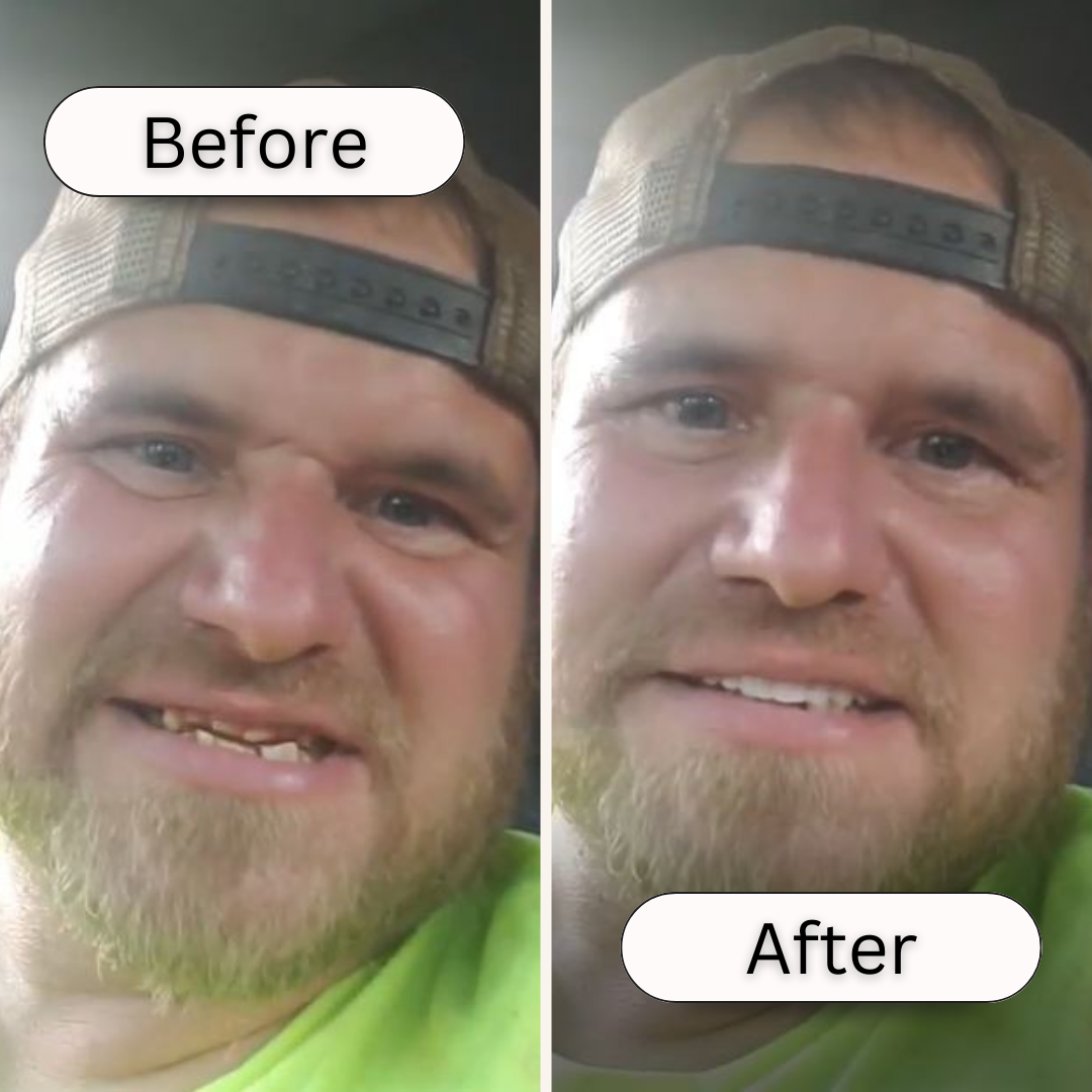 At Home Smile Veneer Kit Easy Tooth Repair