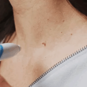 Easy Hair Removal at Home in 10 Days