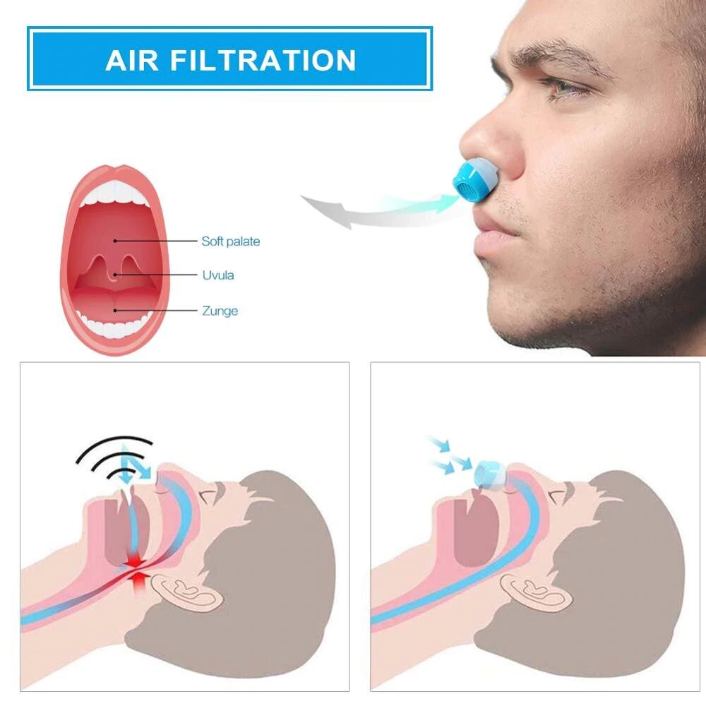 Compact Sleep Apnea Relief Device