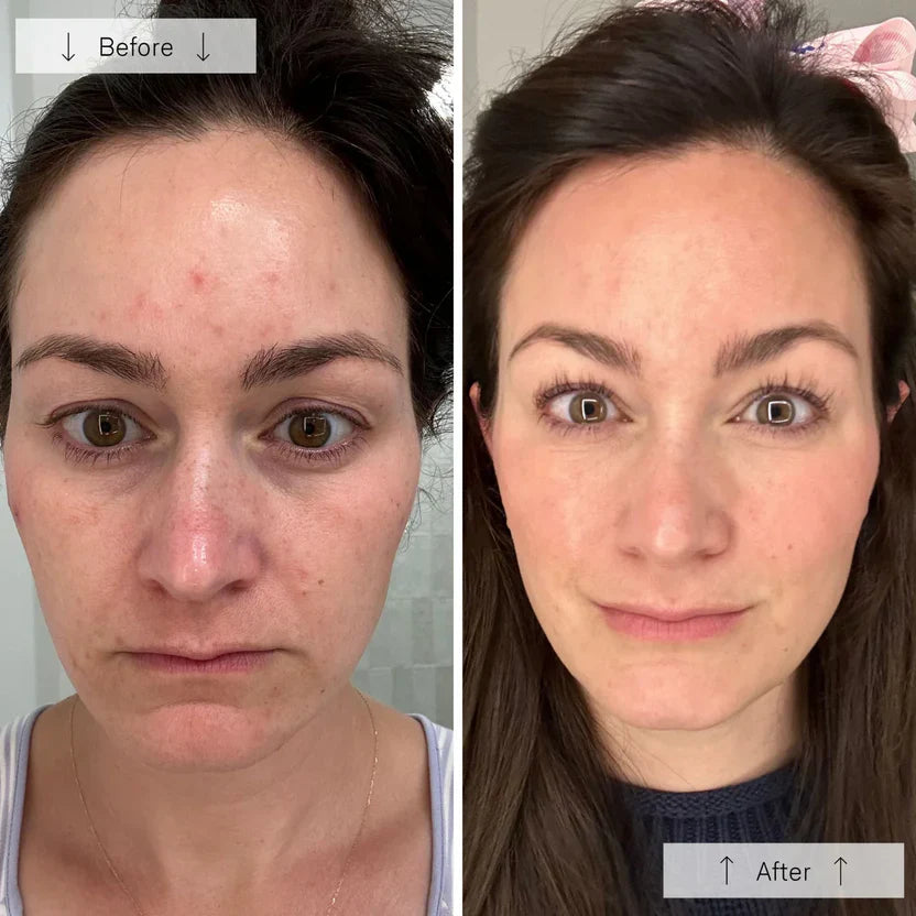 Advanced LED Face Mask for Skin Rejuvenation Therapy