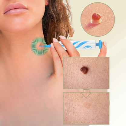 Easy Wart and Mole Remover for Home Use - Luxicro