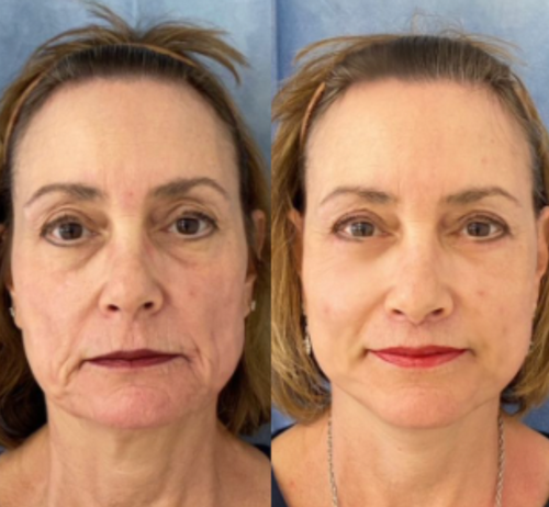 Advanced Collagen Face Mask: Deep Hydrating Anti Aging