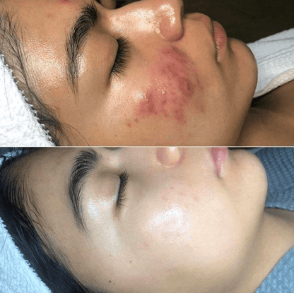 Advanced Skin Rejuvenation With LuminaWand Tool
