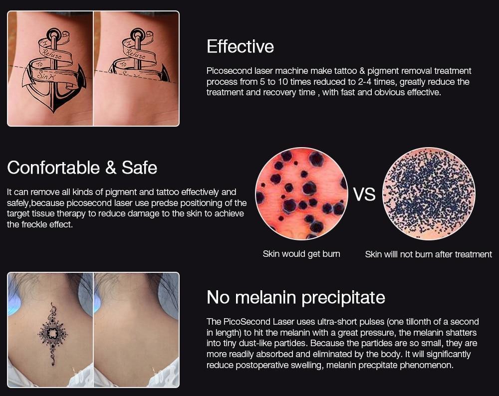 Effective Laser Skin Spot & Tattoo Removal Device