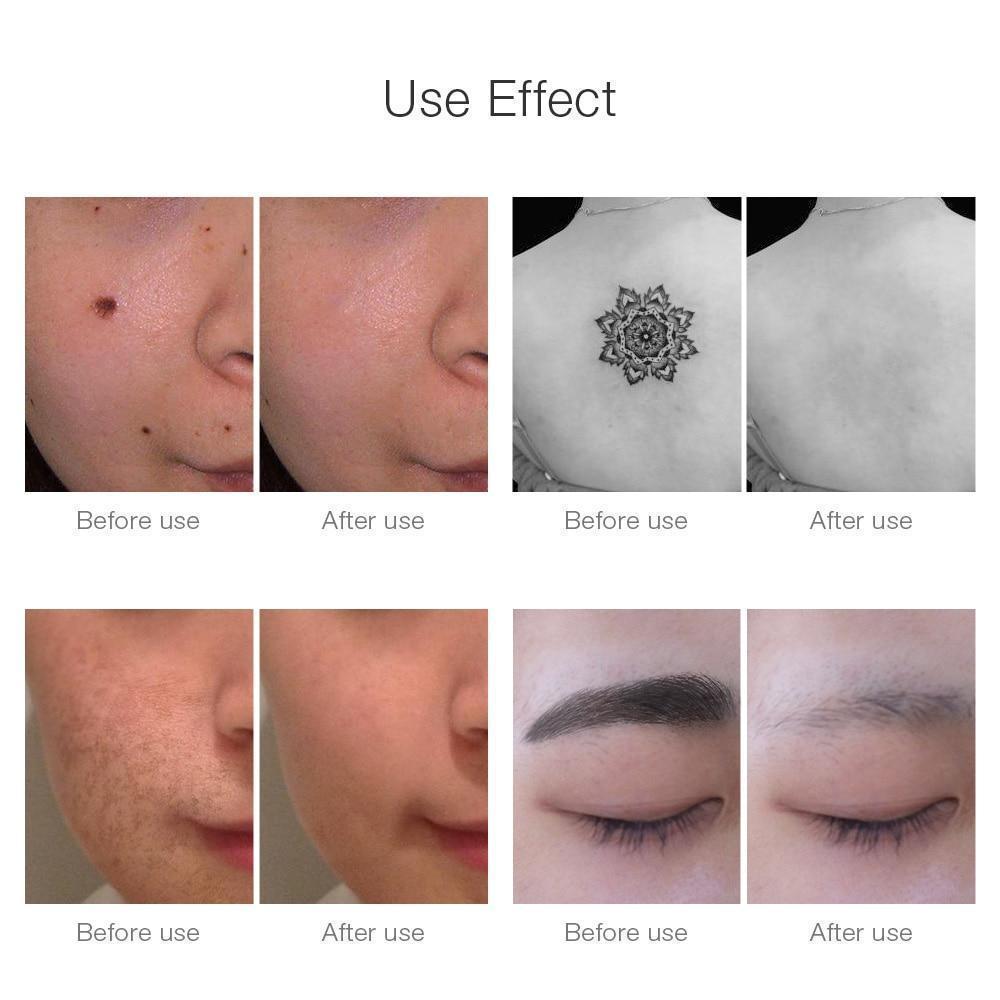 Effective Laser Skin Spot & Tattoo Removal Device