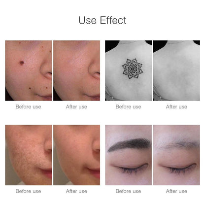 Effective Laser Skin Spot & Tattoo Removal Device